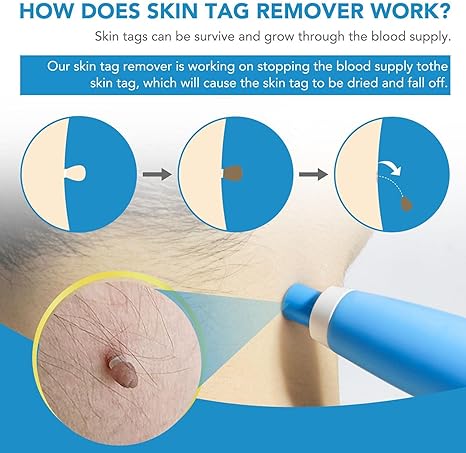 Acrochordon Skin Tag Remover Kit – 2-in-1 Fast & Painless Solution image 3