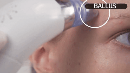 Pore Cleaning Device – Blackhead Remover Vacuum, USB Rechargeable